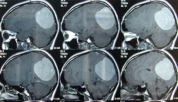 CT-Aufnahmen Gehirntumor CT-Aufnahmen Gehirntumor