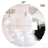 CT-Aufnahmen Gehirntumor CT-Aufnahmen Gehirntumor