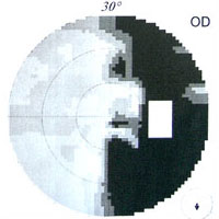 CP-Aufnahmen Gehirntumor CP-Aufnahmen Gehirntumor