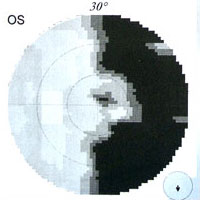 CP-Aufnahmen Gehirntumor CP-Aufnahmen Gehirntumor